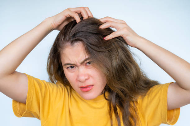 【頭皮問題】頭經常痕癢、多頭皮屑可能是頭皮炎？頭皮發炎症狀你中了幾個？