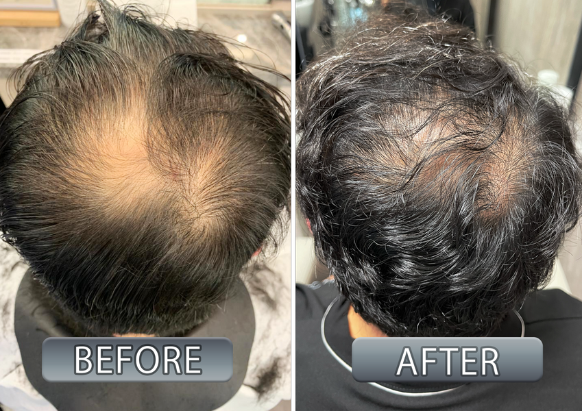 【解決脫髪問題其實可以很簡單】阿康的26天頭髮重生真實例證